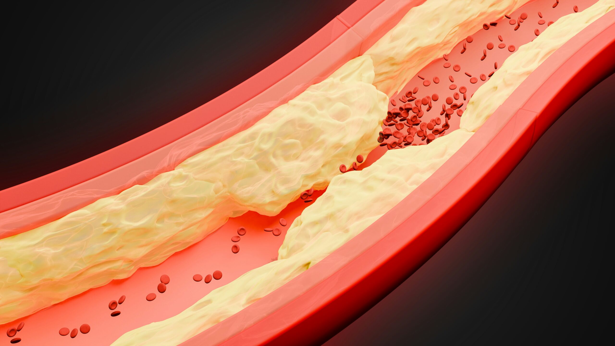 What Raises The “Bad” Cholesterol (LDL) Levels?